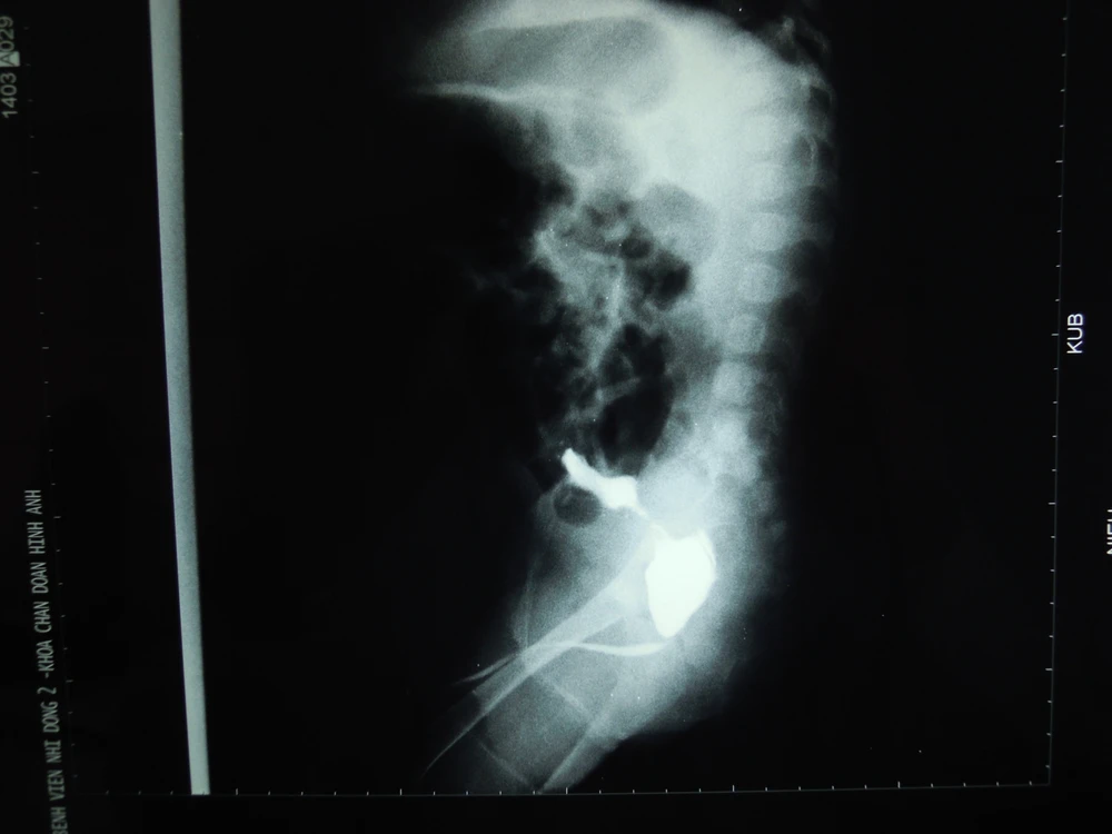 Trẻ bị vỡ bàng quang do dị tật niệu ảnh 1